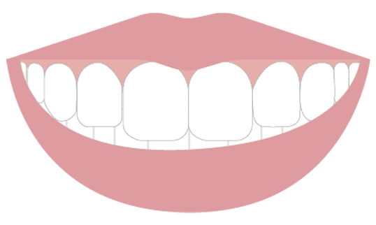 歯茎の露出量