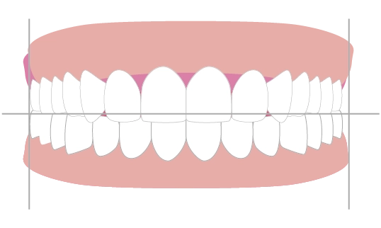 歯ぐきのライン