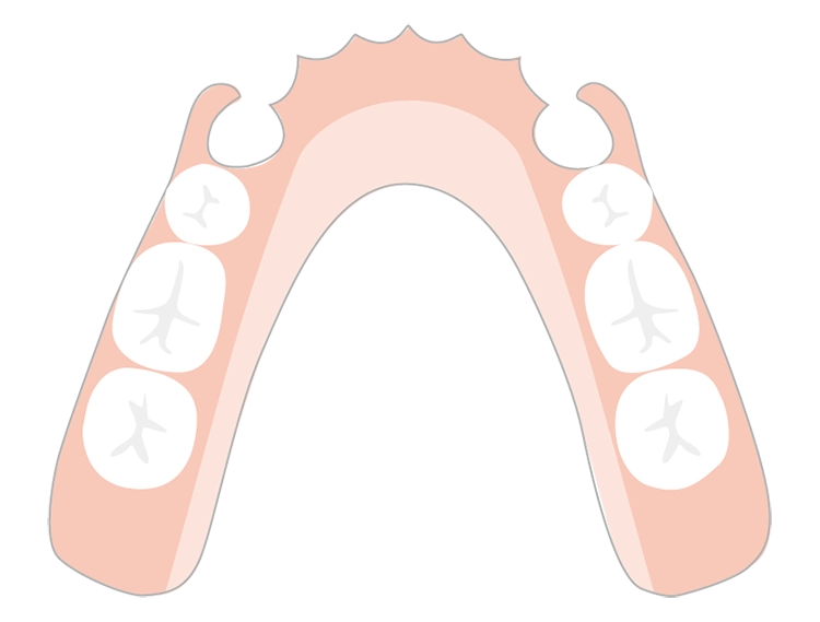 部分入れ歯