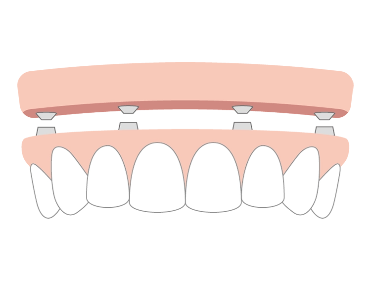 マグネット入れ歯