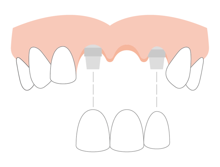 インプラント義歯