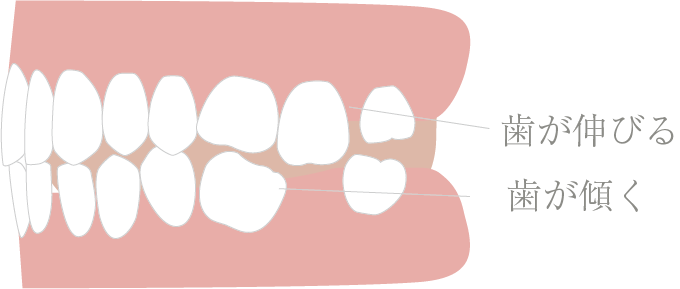 歯は1本欠けると連鎖的にトラブルが広がります