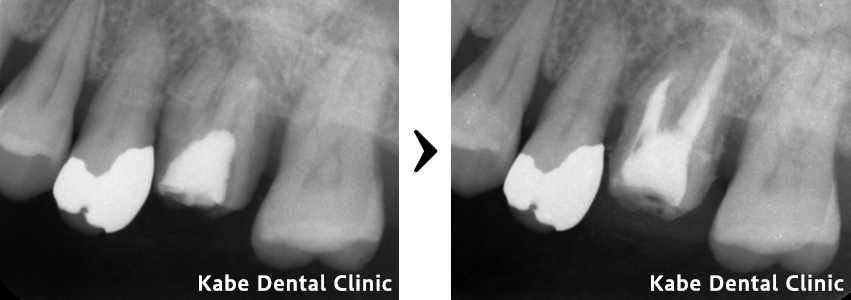 虫歯と歯周病を併発していた方