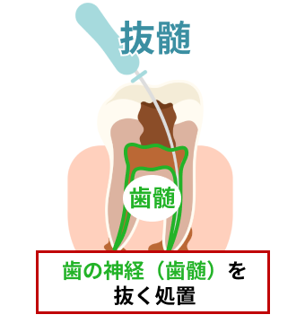 抜髄はどんな治療