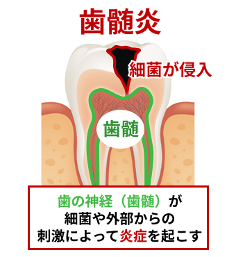 歯髄炎とは