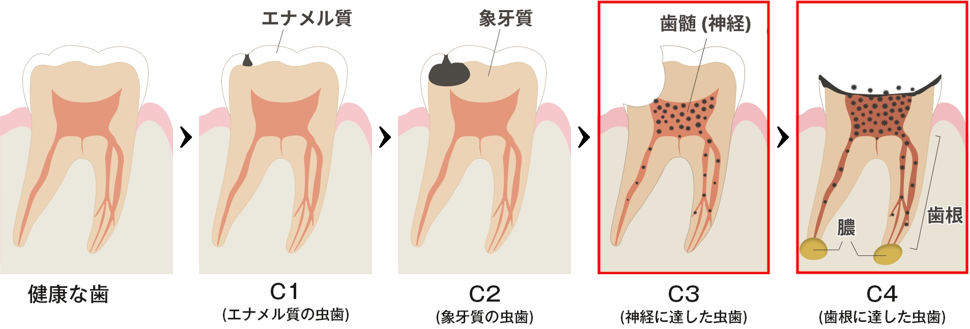 歯髄炎の症状の進行